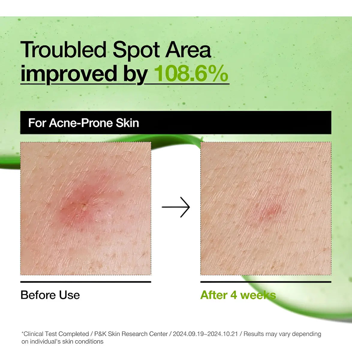 Anua Azelaic Acid 10 Hyaluron Redness Soothing Serum 30ml